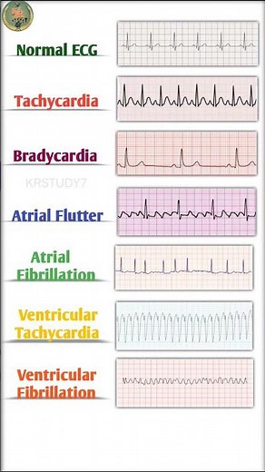 ECG Types in 10 Seconds | Normal vs Abnormal ECG | GNM/ANM #nursing #ecg