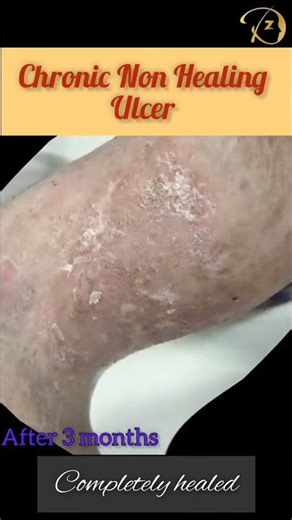 Chronic Non Healing Ulcer- successfully treated! #happypatients #happydoctor