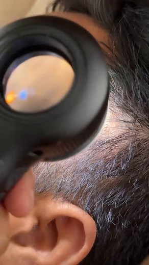 Medical Network | Up close and personal with @dermoscoppic showing us Seborrheic keratosis - #dermoscopy #dermoscope #derm #skinlesion #dermatology... | Instagram