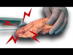 How does BodyTite, FaceTite Radiofrequency assisted lipolysis RFAL energy based skin tightening work