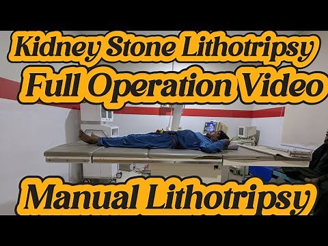 kidney stone laser treatment | laser treatment for kidney stone | lithotripsy procedure video