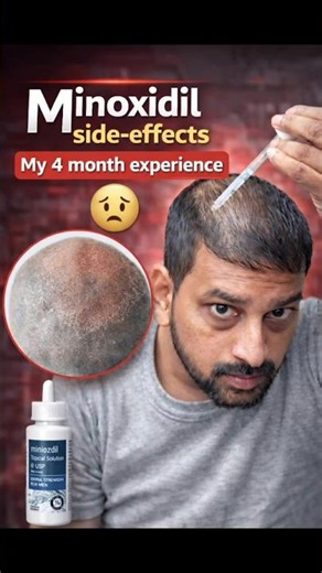 Minoxidil Side Effects 😱 Myth ya Truth? | Sach jaan lo !