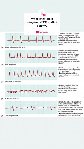 #question from @clshealthcaretraining Ventricular fibrillation (V-fib) is the most serious arrhythmia and is a life threatening medical emergency. Disordered electrical signals in the heart cause the ventricles to quiver instead of pumping normally. #acls #aclstraining #aclsskills #aclsalgorithm #aclscertification #newgradnurse #ekginterpretation #megacode #codeblue #codebluememes