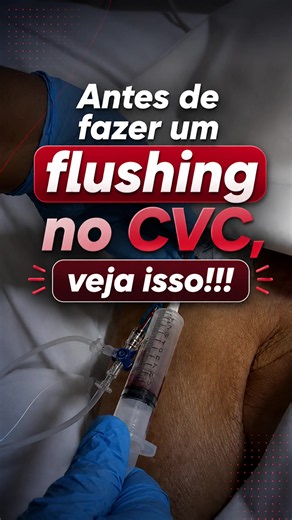 Oi gente!!!! De hoje no estágio de UTI NA PRÁTICA 5.0 !!!! 🚨 Quando você desliga uma droga vasoativa, um sedativo ou um antiarrítmico, qual é a sua conduta? Você faz o flushing imediatamente ou aspira o conteúdo residual do lúmen antes de realizar o flushing? Esse pequeno detalhe, que leva apenas alguns segundos, pode fazer uma enorme diferença na segurança do paciente. IMPORTANTE !!!! ATENÇÃO!!!! Ao aspirar o sangue residual do lúmen antes do flushing, você reduz o risco de administrar um bolu