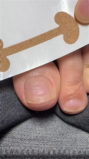 MaviGadget on Instagram: "Product Link in Bio⁠ ⁠@mavigadget ⁠ The Toe Align Ingrown Nail Corrector Stickers gently guide nail growth to reduce pressure and discomfort. Designed for daily use, they help prevent painful ingrown nails and support healthier alignment for long-term relief. Simple, effective, and easy to apply.⁠ ⁠ Product: Toe Align Ingrown Nail Corrector Stickers⁠ ⁠ 1️⃣ no copyright intended. DM for inquiries.⁠ ⁠ ingrown nail treatment, toe nail corrector, foot care tool, nail alignm