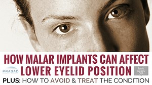 Asymmetry After Malar Implant Removal — A Doctor Provides Solutions