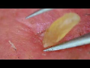 0328 keratin plug removal nose