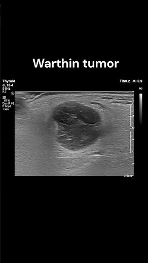 Parotid Mass - 2 #ultrasound #imaging #tumors #cases