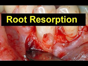 Internal and External Resorption Case Presentations
