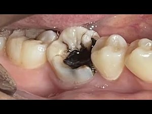 What Expect!😮Professional Teeth Cleaning A Dentist's Step-by-Step