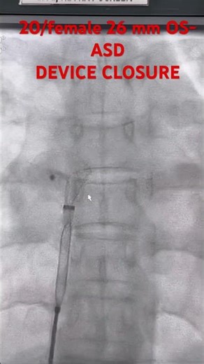 20/female OS ASD DEVICE CLOSURE