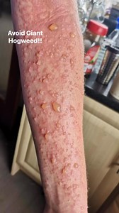 Read the article here https://www.oak.scot/post/giant-hogweed-poisoning?fbclid=IwQ0xDSwKr0MRleHRuA2FlbQIxMQABHq1yOOtOaUJb5QRYcR3Ojp5M80joOTFhe_oY3oDTWr5OU7OwFMTY1-47l-oQ_aem_mB_MDEmjXm_QG-y54Ho_iw thanks Caroline Greene | Eat The Country