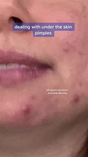 Dealing with Under the Skin Pimples: A Step-by-Step Guide