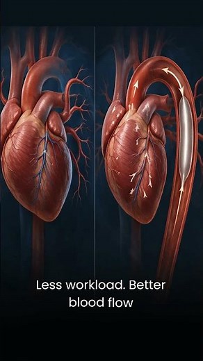 IntraAortic Balloon Pump (IABP): A HeartSaving Device Explained