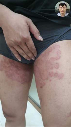 Hắc Lào Đây Là Dấu Hiệu Của Một Ca Điều Trị Thất Bại Kéo Dài