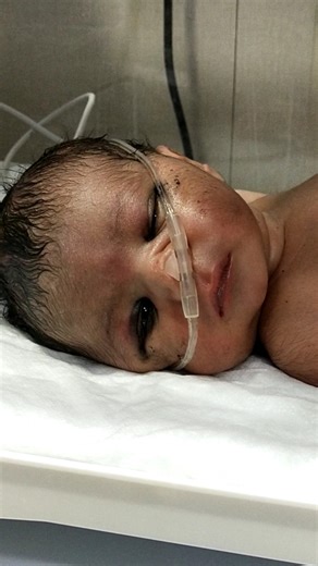 Severe Fits in Newborn Baby 😢 | Critical NICU Case – Please Pray#neonatologist #nicu 🙏”