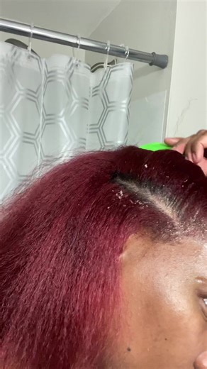 How to Effectively Remove Dandruff and Scalp Psoriasis Flakes