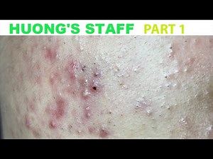 Acne Treatment Huong Da Nang#748#Huong's staff_ Part1 Blackheads and inflammation TET Holiday