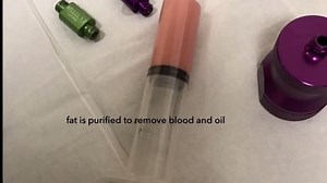 Fat Transfer: Nanofat Harvest and Facial Injection with PRP (GRAPHIC)