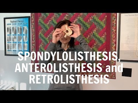 Spondylolisthesis, anterolisthesis and retrolisthesis explained by Irvine Chiropractor