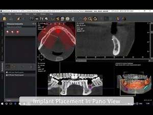 QuickVision 3D - Implant create and place - OWANDY RADIOLOGY
