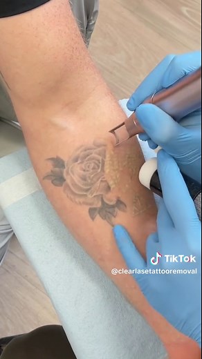 Effective Tattoo Removal Process Explained