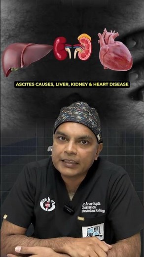 Ascites: A Dangerous Condition | Causes and Treatment Options #ascites #fluid #stomachproblem