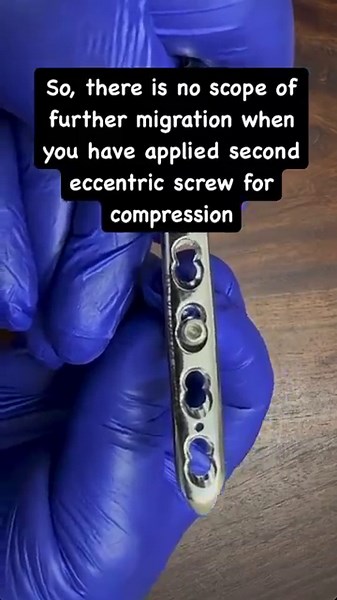 Why 2 mm only compression with Dynamic compression plating principle