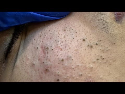 Pore Cleaning Bliss ASMR - Acne & Blackhead Removal with Facial Care Routine