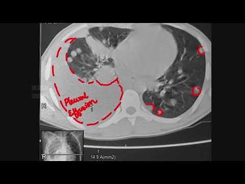 Pulmonary / Lung Metastasis • Radiology and Mechanism