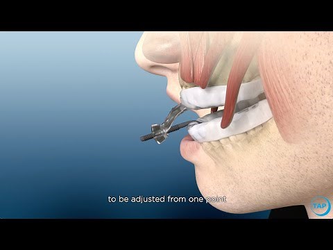 myTAP Oral Appliance for Snoring & Sleep Apnea: How Does It Work?