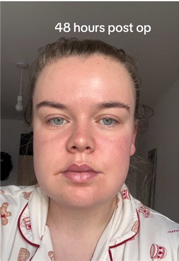 Recovery Timeline After Wisdom Tooth Surgery