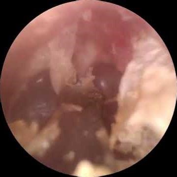 AIR Lock ear wax removal part 13