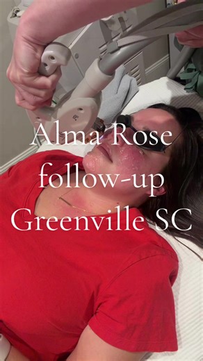 Secon appointment for Rosacea & broken capillaries using IPL YAG laser! I went to Alma Rose Med Spa to target redness, flushing, and visible capillaries—here’s what my skin actually looks like now. If you deal with rosacea or facial redness, this is your sign to look into it. I’ll keep sharing the real results healing process. Follow along. #rosacea #rosaceatreatment #rosaceaskin #ipl #lasertreatments