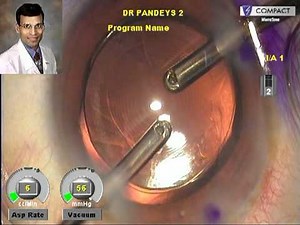 First Piggyback Implantation of Multifocal & Toric IOLs to Correct High Hyperopia.mpg
