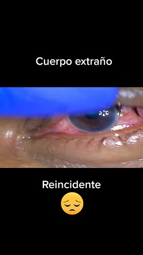 Eye Cyst Extraction: Clinical Close-Up Procedure