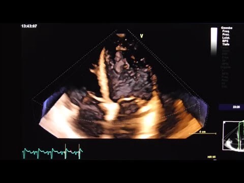 Left ventricular thrombus