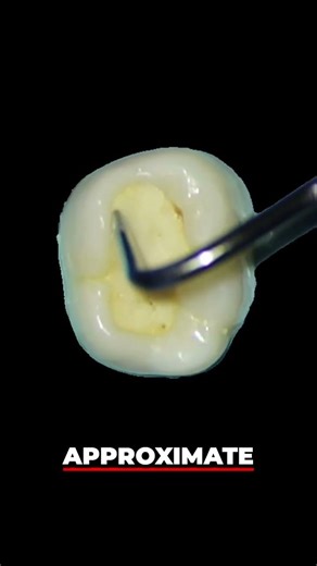 Root Canal Access A Step by Step Guide