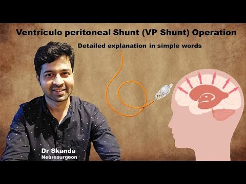 Ventriculo Peritoneal Shunt (VP Shunt) Operation. Hydrocephalus. Simple explanation by Dr Skanda