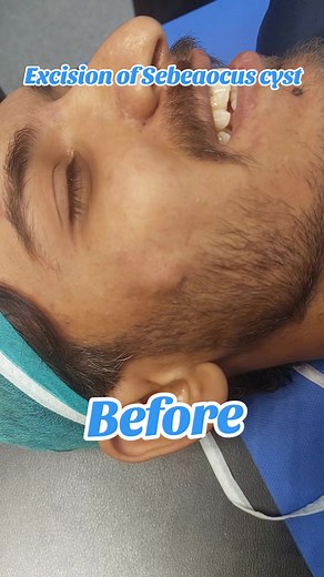Sebaceous Cyst Surgery Insights with Dr. Tayyab
