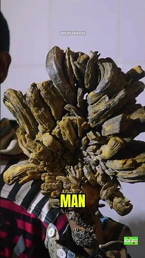 What Is Tree Man Syndrome? 😱
