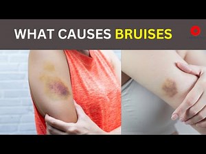 Bruises - Why does it happens? | Symptoms, Causes and treatment