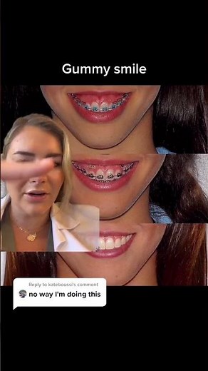 #greenscreen Another gummy smile example! #ortho #orthodontist #braces #braceson #bracesoff