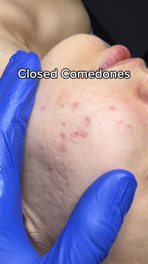 Jay Nguyen • Acne Specialist 🇨🇦 🇻🇳 | Closed comedones are those tiny, flesh colored bumps that never seem to go away. They’re often mistaken for “texture,” but they’re actually... | Instagram