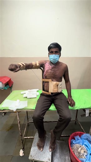 How an ideal aeroplane splint should be applied and work in a post burn Axilla contracture release