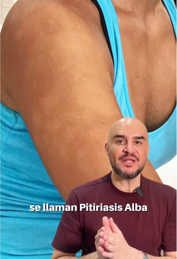 Pitiriasis Alba: Causas, Síntomas y Tratamientos