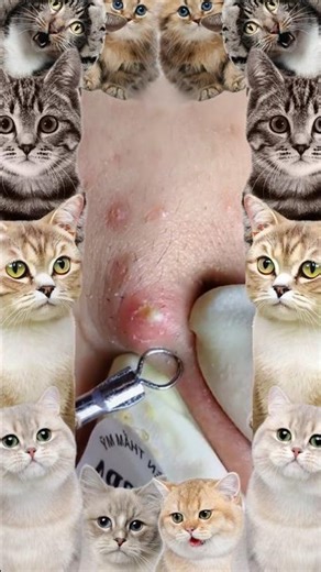 Blackheads Removal | Acne Treatment and Very Satisfying Satisfying Pimple pop #blackheads