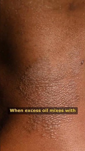 How to Remove Blackheads Permanently Best Skincare Tips for Clear, Smooth Skin