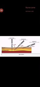 Difference Between IM, SC & ID Injection Angles in 30 Seconds!