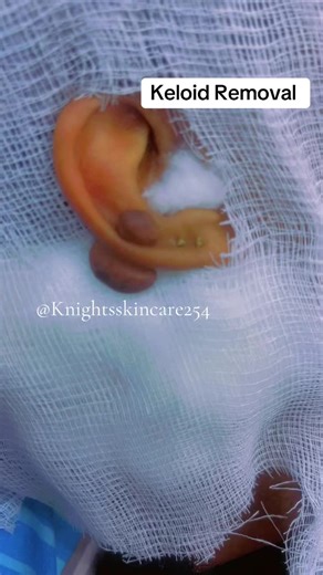 Effective Keloid Removal Techniques for Clearer Skin